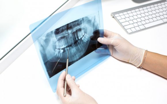 Dental X-Rays are safe
